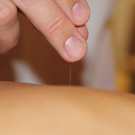 Eaux-Vives Santé - Ricardo Camilo - Acupuncteur et physiothérapeute - Genève - traitement acupuncture avec aiguille
